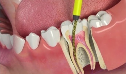 Painless Root Canal Treatment