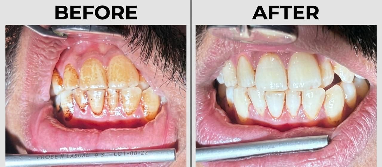 Smile Makeover Before and After